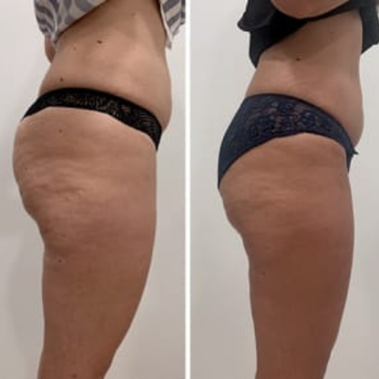 Masajeador 4 en 1 - Despídete de la Celulitis en Menos de 20 Minutos al Día